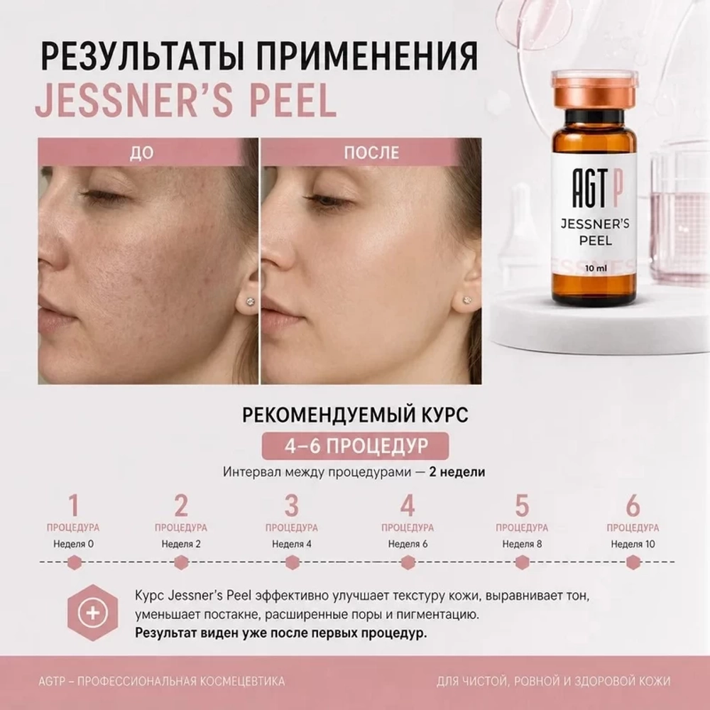 Jessner’s Peel AGT Р