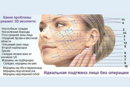 Армирование мезонитями по зонам лица