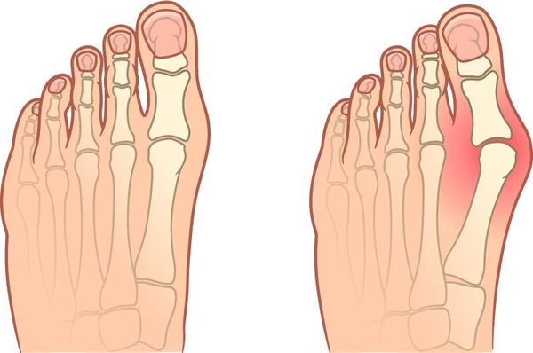 Вальгусная деформация стопы - Hallux Valgus