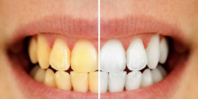 На зубах образовался желтый налет - эффективно справится Oil pulling кокосовое масло &amp; чайное дерево.