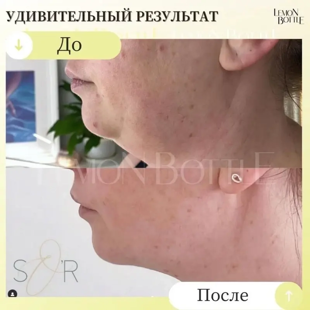 LemonBottle Ampule Solution | Липолитик непрямой