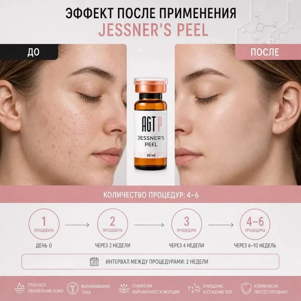 Jessner’s Peel AGT Р