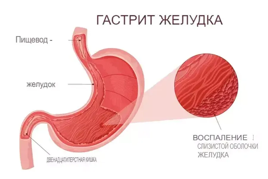 Что такое гастрит? Что такое гастрит?