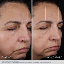 Obagi ELASTIderm Advanced Filler Concentrate Гель-концентрат от морщин 20 мл