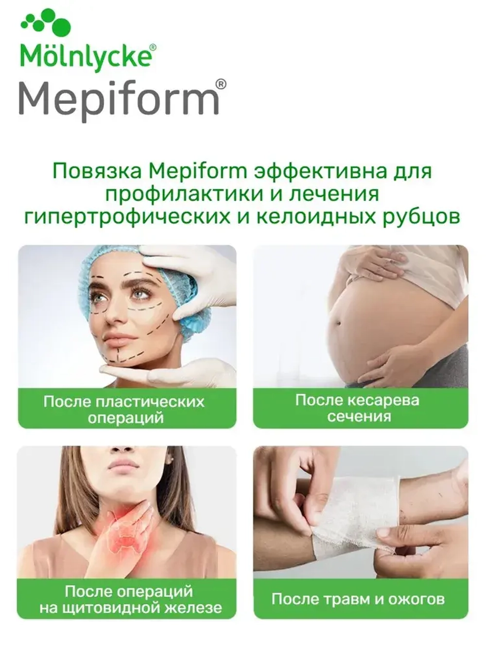 Мепиформ/ Мепиформ 4х30см, 1шт для лечения рубцов