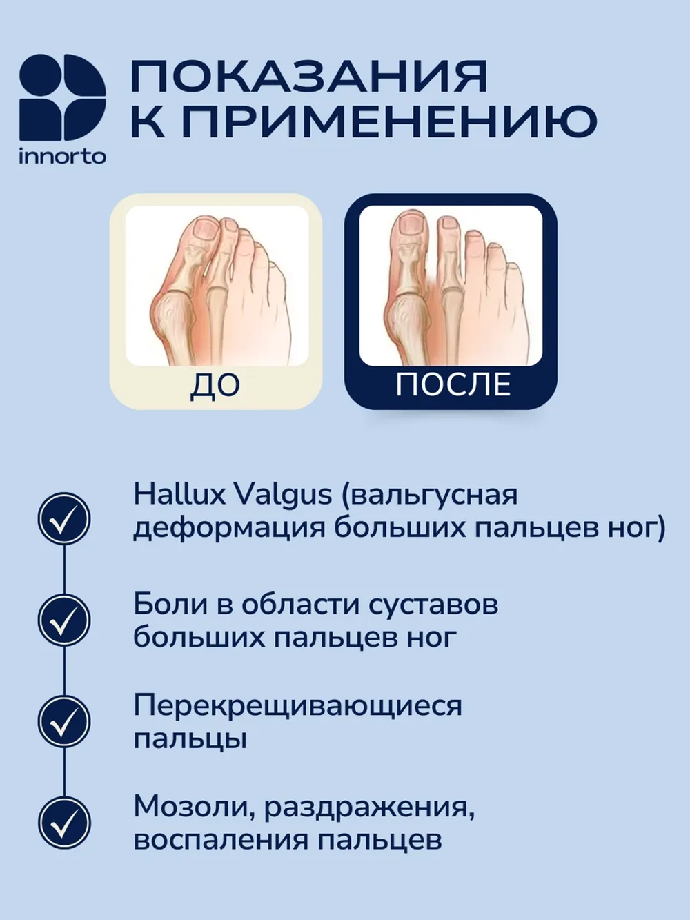 Вальгусный корректор большого пальца