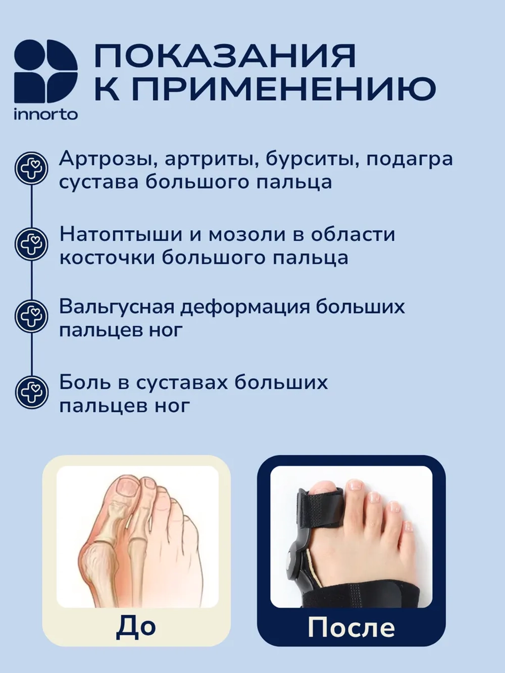 Вальгусная шина от косточки (шарнирная), 2 шт