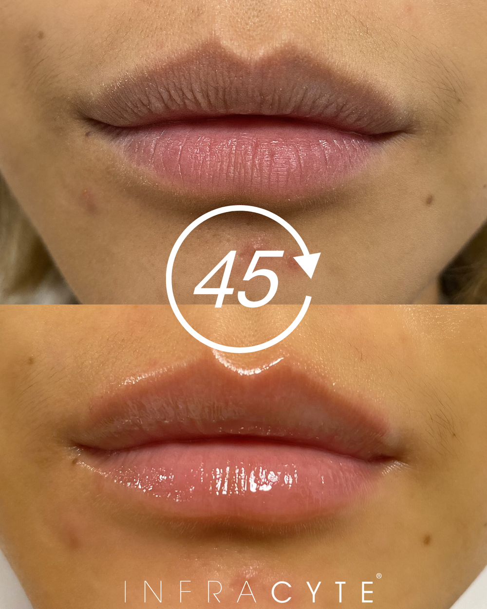L.I.T. (Lip Infusion Therapy) 1 патч-маска