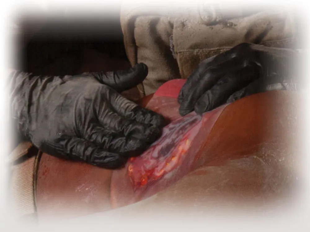 Прозрачный клейкий пластырь (6х6 дюймов) HyFin Chest Seal North American Rescue