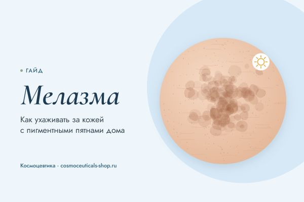 Мелазма: как ухаживать за кожей с пигментными пятнами дома