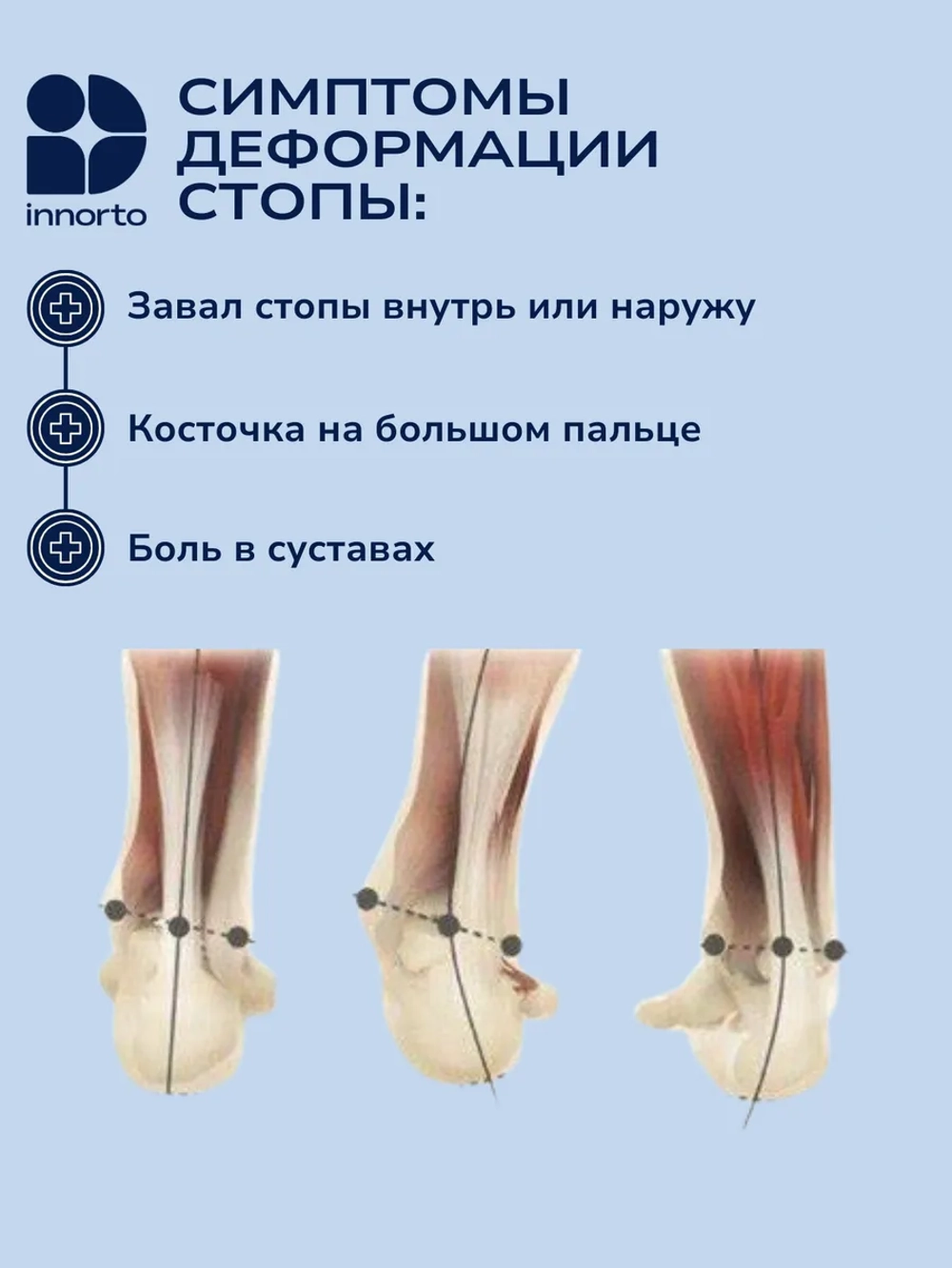 Подпяточник при вальгусной деформации