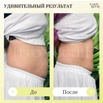 LemonBottle Ampule Solution | Липолитик непрямой