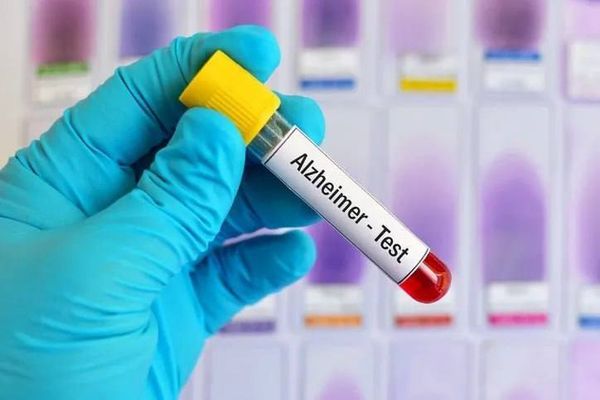 Исследователи выявили недостатки в многообещающих анализах крови для диагностики болезни Альцгеймера. Исследователи выявили недостатки в многообещающих анализах крови для диагностики болезни Альцгеймера.