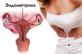 Как лечить эндометриоз?
