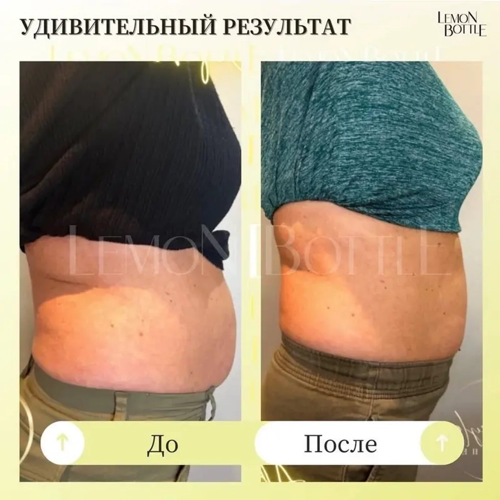 LemonBottle Ampule Solution | Липолитик непрямой