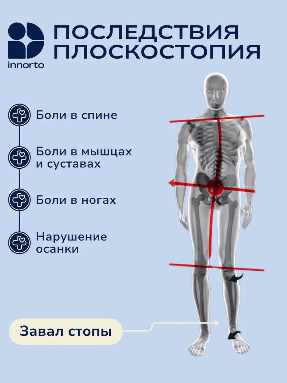 Супинаторы ортопедические для обуви