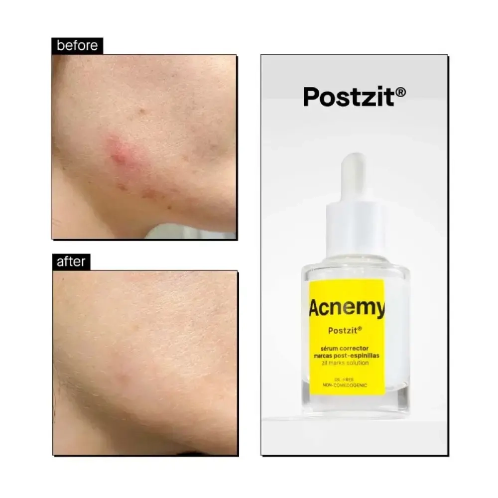 Сыворотка Acnemy PostZit против постакне