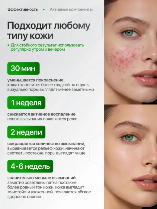 Del Monaco Крем для проблемной кожи лица от акне и прыщей с азелаиновой кислотой, 30 мл