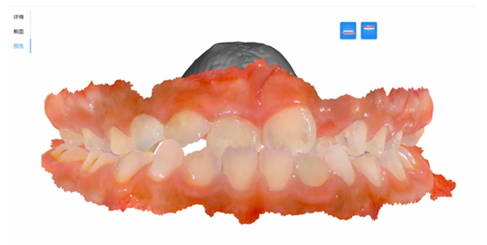 Интраоральный 3D сканер MaxOral V1