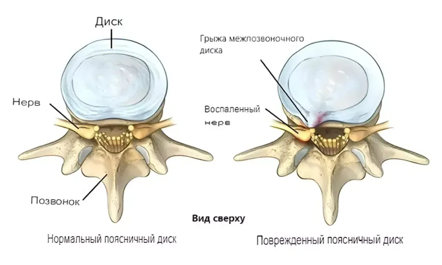 Позвоночная грыжа Позвоночная грыжа