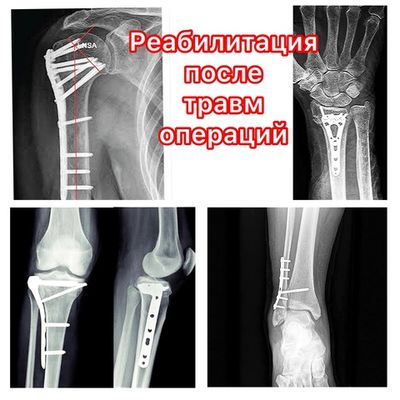 ЛФК Разработка сустава Послеоперационная контрактура