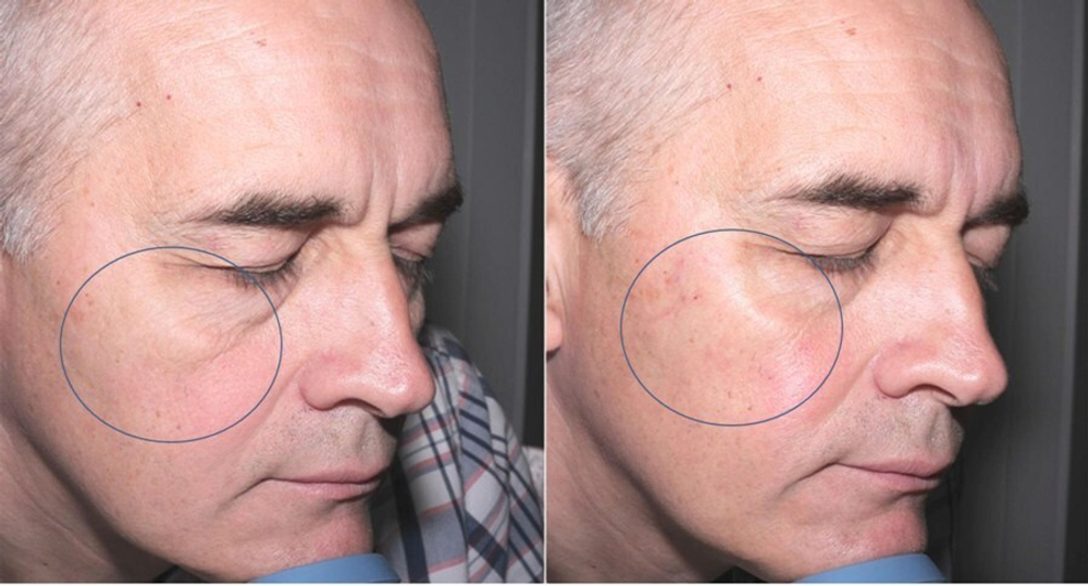Cytocare S Line Revitacare | ГК 6мг/мл+CT50 | Биорепарант